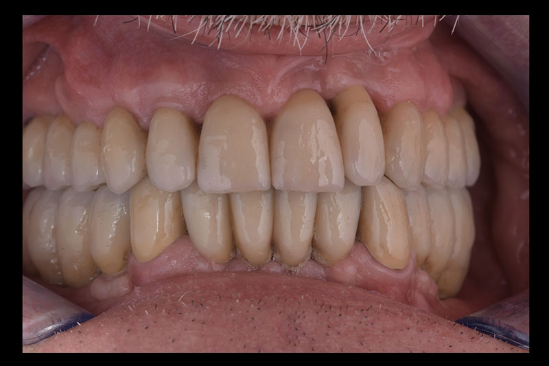 Riabilitazioni complesse su denti e impianti