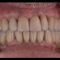 Riabilitazioni complesse su denti e impianti